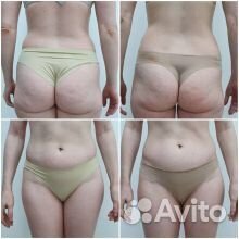 LPG массаж на аппарате оригинал пр-ва Франции