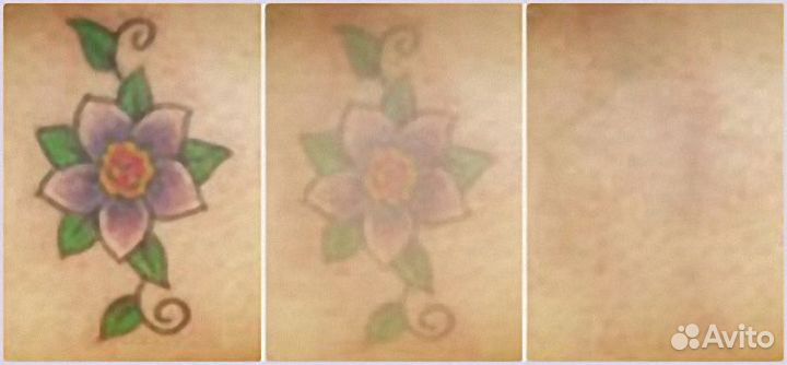 Лазер для удаления тату с обучением