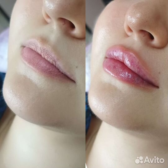 Модель на увеличение губ
