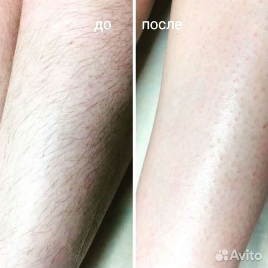 Депиляция воском: бёдра