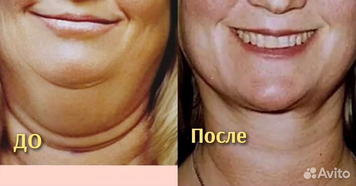 Шея, подтяжка