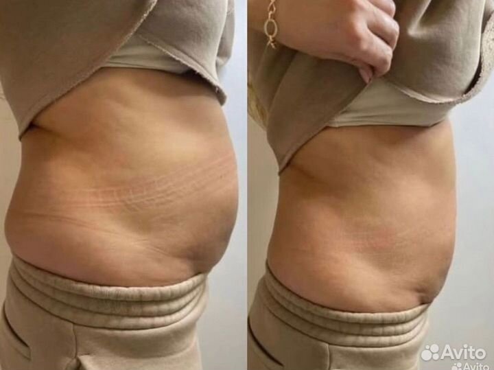 Криолиполиз похудение