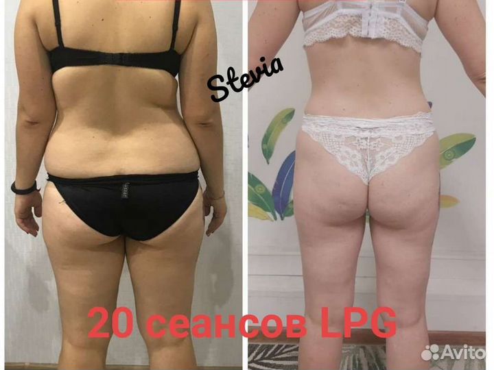 Lpg массаж м.Московская