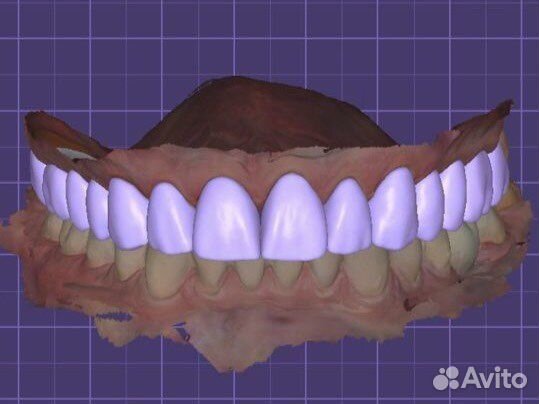 Моделировка в exocad