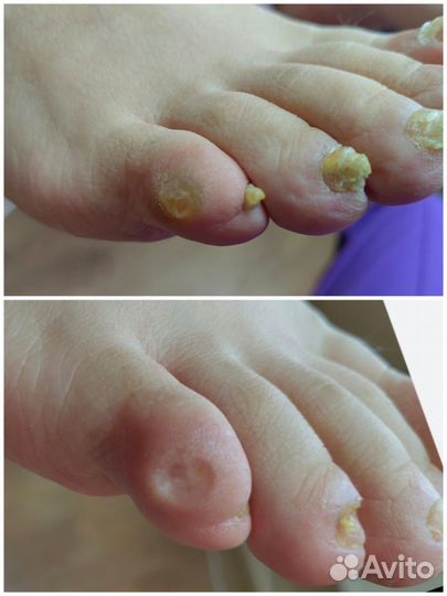 Медицинский педикюр, подолог