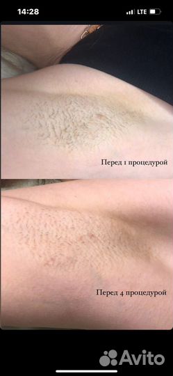 Электроэпиляция