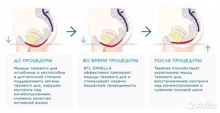 Кресло UmSella для укрепления мыщц тазового дна