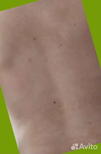 Мазь от псориаза