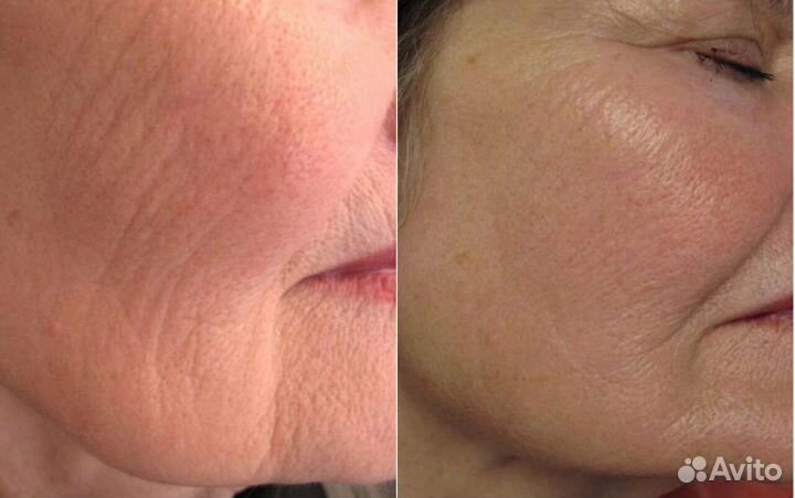 Rf лифтинг микроигольчатый