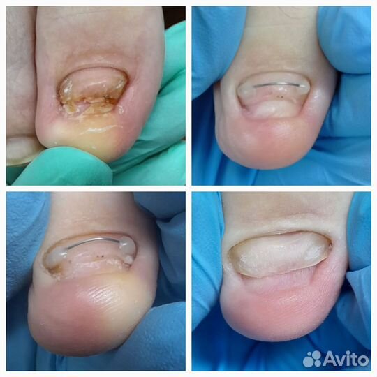 Коррекция вросшего ногтя