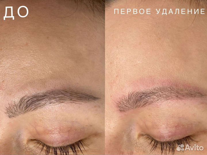 Лазерное удаление татуажа и тату