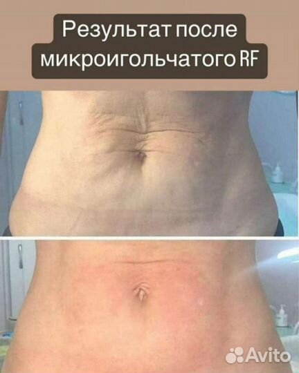 Rf лифтинг микроигольчатый