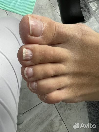 Отслоение Травмированный ноготь Подолог