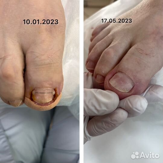 Обработка стоп и ногтей у Вас дома