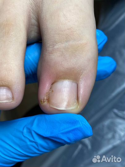 Требуются модели на удаление вросшего ногтя