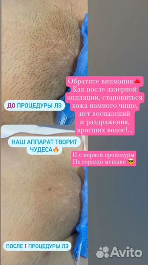 Лазерная эпиляция диодный лазер