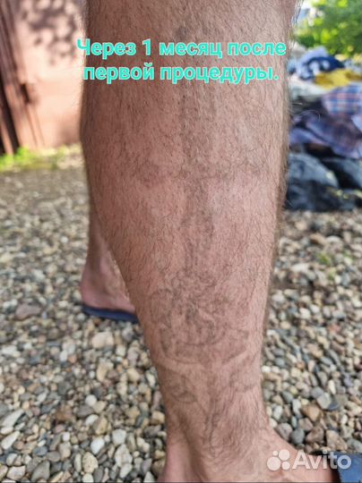 Удаление татуировки/татуажа лазером