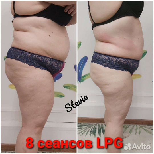 Lpg массаж м.Московская