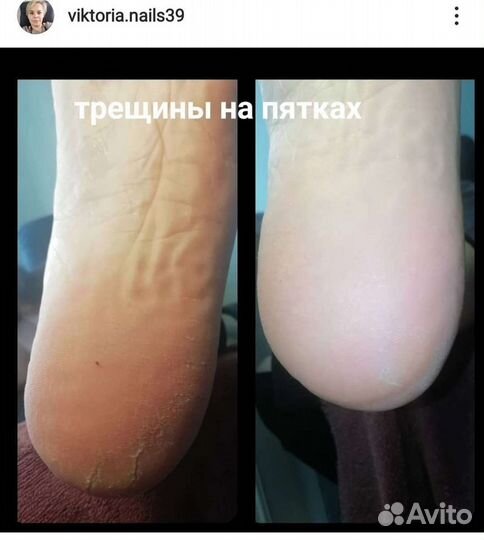 Гигиеническая обработка