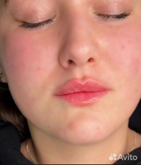 Увеличение губ