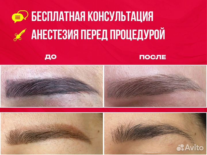 Лазерное удаление татуировки, татуаж, перманент