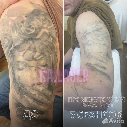 Лазерное Удаление тату и татуажа