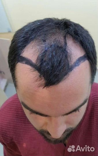 Пересадка волос без швов, рубцов и шрамов