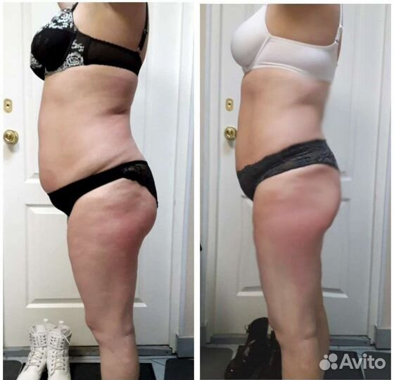 Антицеллюлитный массаж, аппаратный