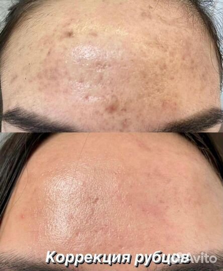 Микроигольчатый RF лифтинг