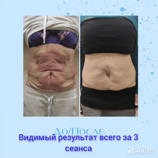 Криолиполиз