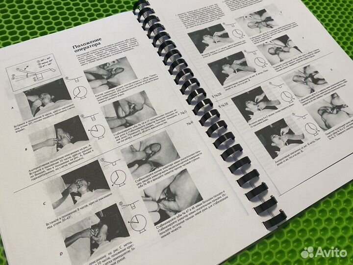 Удаление третьих моляров