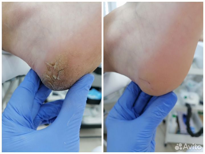 Сертифицированный подолог, лечебный педикюр