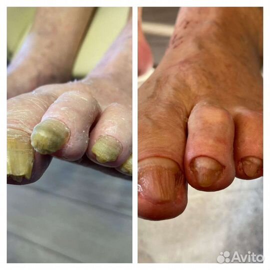 Подолог. Лечебный педикюр. Без боли