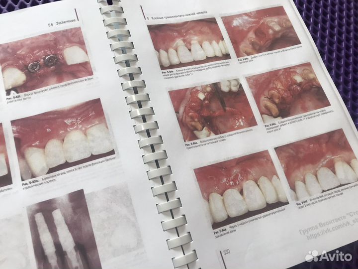 Регенеративные методы в имплантологии