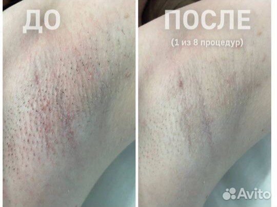 Лазерная эпиляция