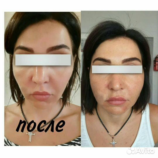 СМАС лифтинг лица и тела