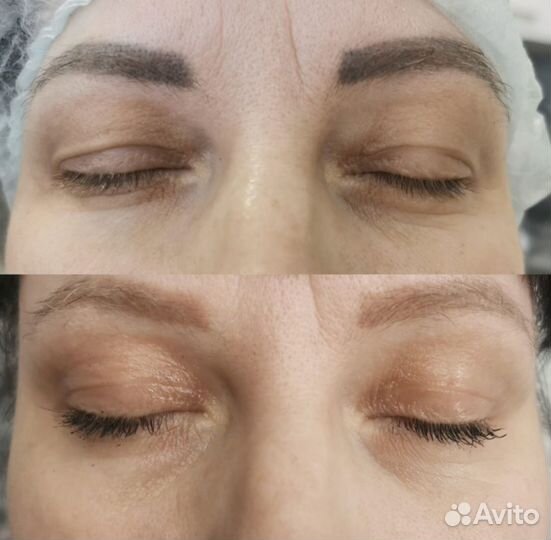 Холодная плазма Тольятти