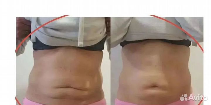 Плоский живот - размер за 1 процедуру Рост на Дону