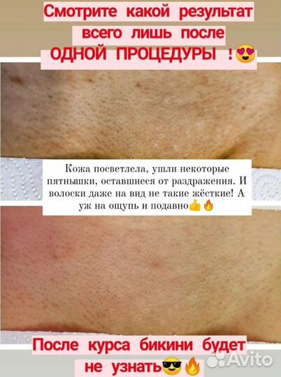 Лазерная эпиляция