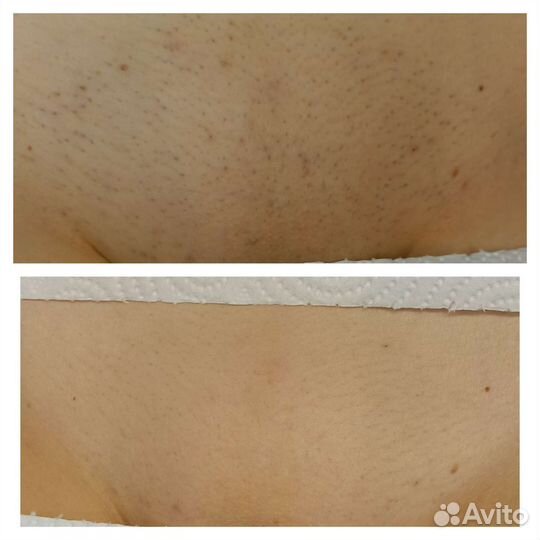 Лазерная эпиляция