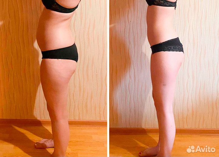 Модели на Криолиполиз Живота