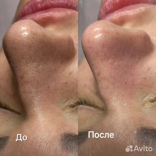 Чистка лица