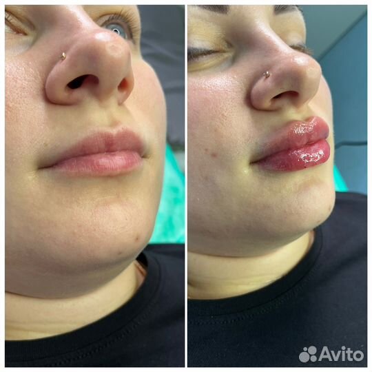 Модель на увеличение губ