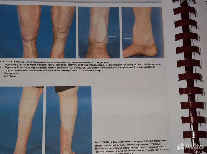 Мягкие ткани в травматологии книга