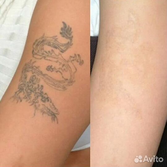 Удаление татуажа и тату