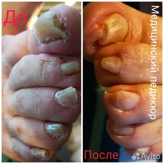 Медицинский педикюр.Выезд на дом.Любой р-он