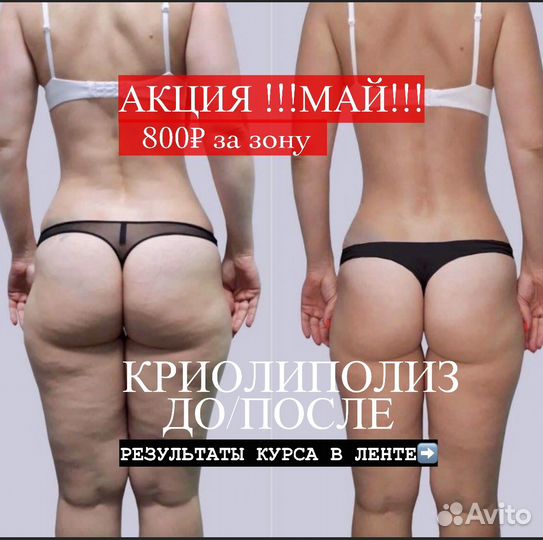 Криолиполиз липосакция без операции