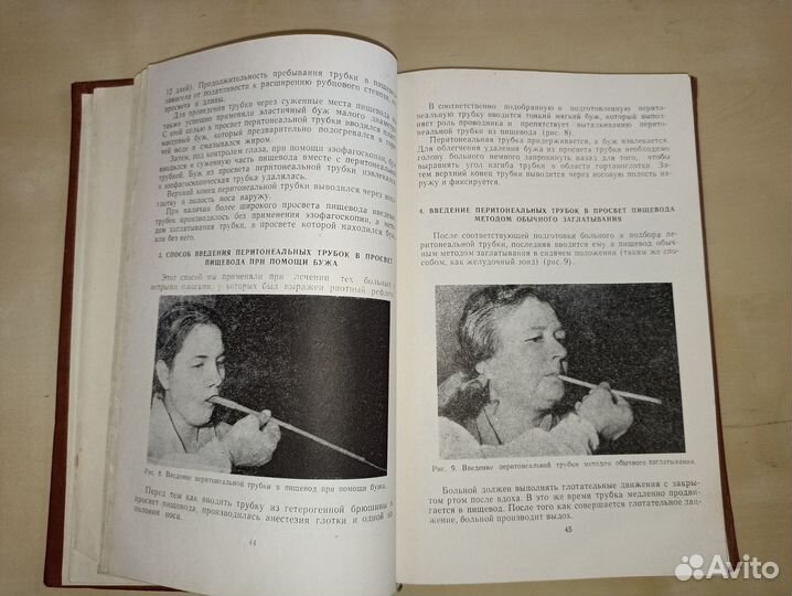 Лечение острых ожогов и стенозов пищевода.1961