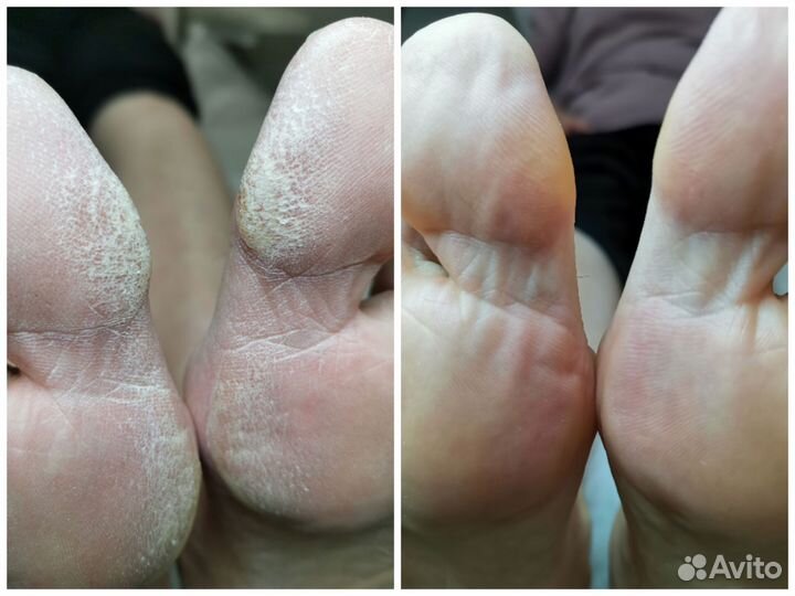 Подологический педикюр