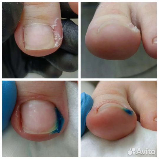 Педикюр аппаратный.парамедицинский